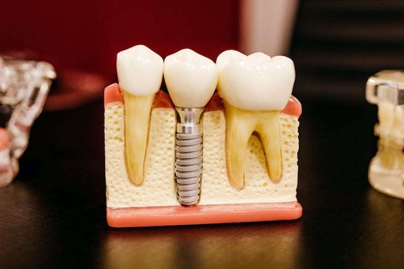 Samples of teeth to make implants