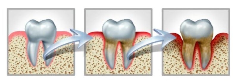 Drawing of three molars. 